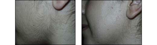 Before and After Photos