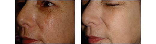Before and After Photos