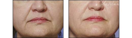 Before and After Photos