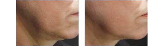 Before and After Photos