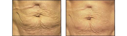 Before and After Photos