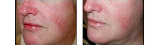 Before and After Photos